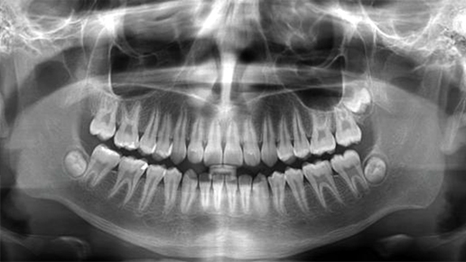 Panoramique dentaire numérique