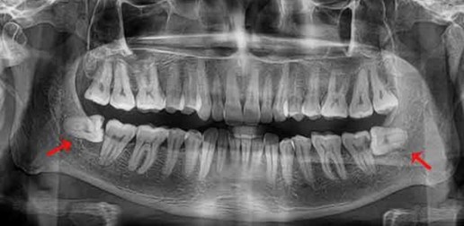 Extraction des dents de sagesse