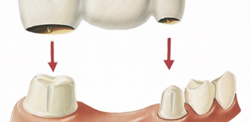 Remplacement de dents manquantes - Ponts