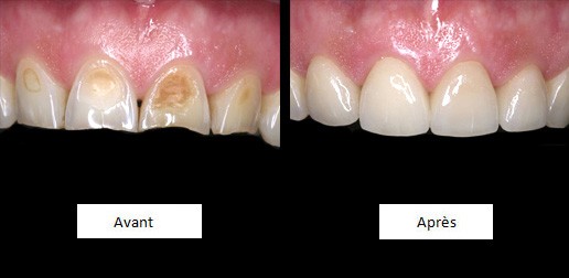 Restaurations dentaires - Facettes