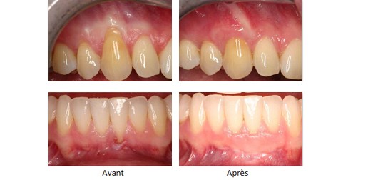 Traitements de gencives - Greffe de gencive