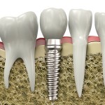 Implants dentaires
