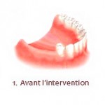 Implants dentaires