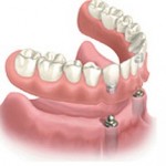 Implants dentaires
