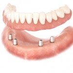 Implants dentaires