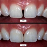 Composite